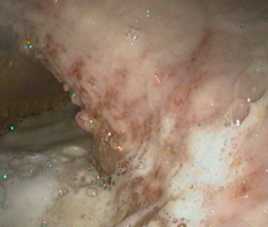 Image endoscopique d'un ulcère chez le cheval