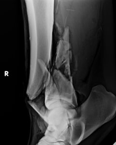 Fracture du tibia du cheval