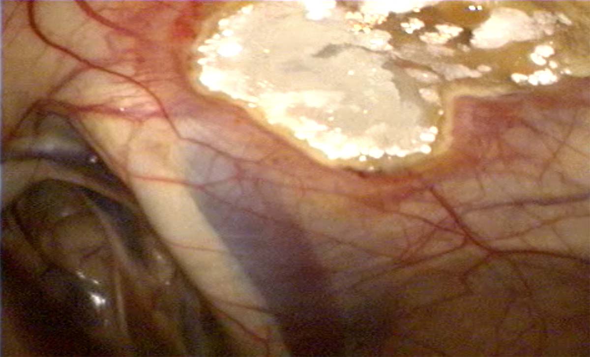 Image endoscopique d’une poche gutturale qui montre la présence d’une plaque mycotique de taille réduite 